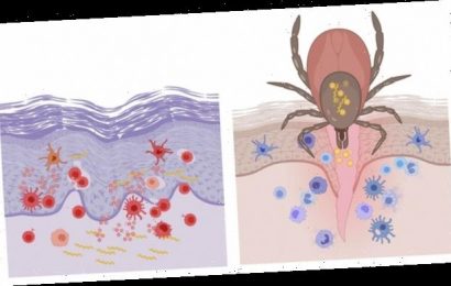 Immunabwehr gestört: Forscher zeigen, was Zeckenbisse gefährlich macht